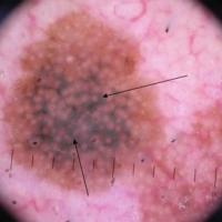 Dermoscopic appearance of previous…