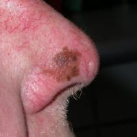 
	Lentigo maligna on the nose

	Asymmetry of…