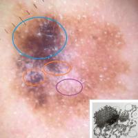 Dermoscopic image of previous figureFollicular…