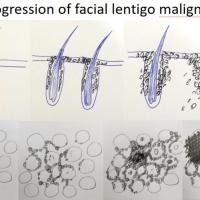Progression of lentigo malignaCopied with kind…