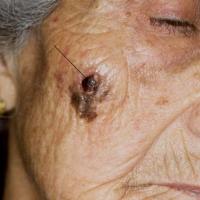 
	Lentigo maligna melanoma&nbsp;

	This lesion…