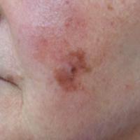 Lentigo maligna melanoma