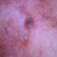 Dermoscopic image of previous figureAdditional…
