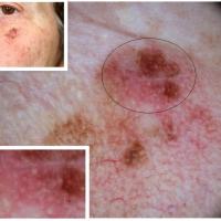 MelanomaRefer to next imageCopied with kind…