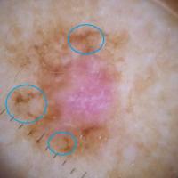 Non-facial lentigo maligna melanomaBroad…
