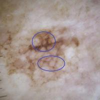 Non-facial lentigo maligna / lentigo maligna…
