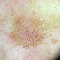 Dermoscopic appearance of previous…