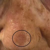 Pigmented actinic keratosis - rough white scale…