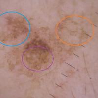 Solar lentigo and evolving seborrhoeic…