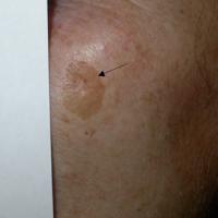 
	Solar lentigo on the left cheek (benign)

	An…