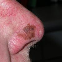 
	Lentigo maligna on the nose
	
	Asymmetry of…