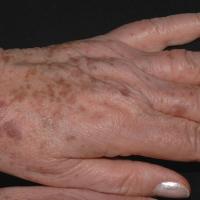 
	Solar lentigines on backs of hands

	Copied…