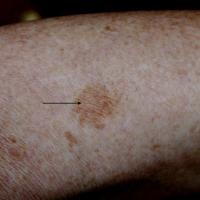 
	Solar lentigo on forearm