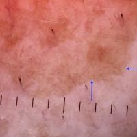 Dermoscopic appearance of previous figureA…