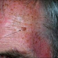 
	Solar lentigo left side of the forehead