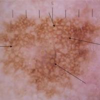 Dermososcopic appearance of previous figureThe…