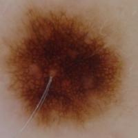 Dermoscopic appearance of previous…
