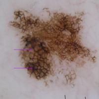 Ink-spot lentigoThis solitary lesion was…