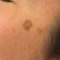 
	Solar lentigo / thin seborrhoeic keratosis on…