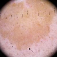 
	Solar lentigo left cheek

	Homogenous…