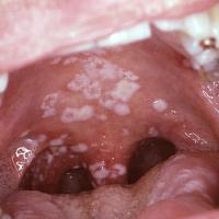 
	Oral candidosis in a patient with HIV