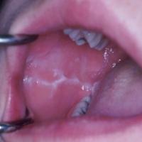 
	Cheek biting