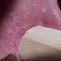 
	Lichen planus on the buccal mucosa