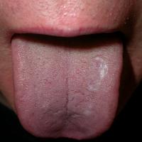 
	Lichen planus on the tongue

	This patient was…