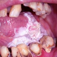 
	Non-homogenous OL - verrucous