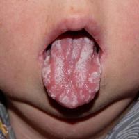 
	Oral candidosis 