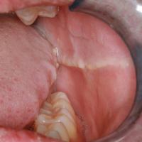 
	Cheek biting

	The lateral margins of the…