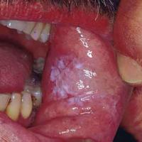 
	Oral candidosis