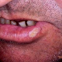 
	SCC lower lip
Copied with kind permission…