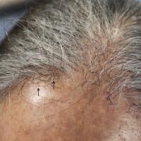 
	Frontal fibrosing alopecia - same patient as…