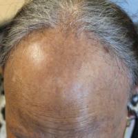 
	Frontal fibrosing alopecia

	This patient was…