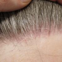 Frontal fibrosing alopeciaScale and erythema…