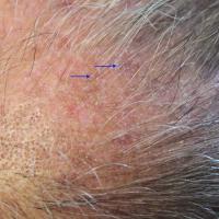 
	Lichen planopilaris - other areas of scalp…