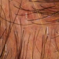 
	Dermoscopic appearance of the previous…