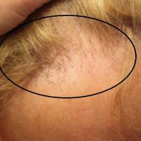 
	Frontal fibrosing alopecia

	Image copied with…