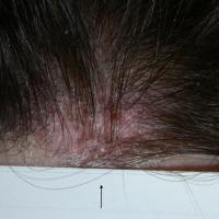 
	Frontal fibrosing alopecia:…