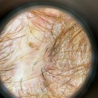 Same patient - dermoscopic appearance 
Scarred…