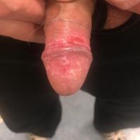Erosive lichen planus - very uncommon in…