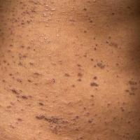 Lichen planus
Copied with kind permission from…