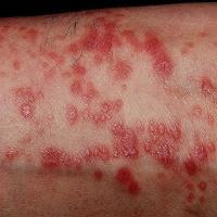 
	Lichen planus on the wrist 
