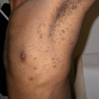 
	Lichen planus pigmentosus
	
	This had never…