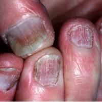 
	Lichen planus causing significant damage to the…