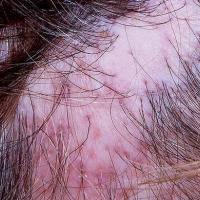 
	Lichen planus and scarring alopecia

	The…