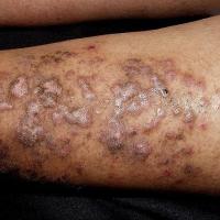 
	Hypertrophic lichen planus
	
	Copied with kind…