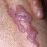 
	Hypertrophic lichen planus, close-up