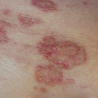 
	Annular lichen planus